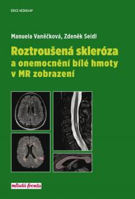 Roztroušená skleróza a onemocnění bílé hmoty v MR zobrazení